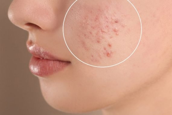 Understanding Acne Causes, Treatment Options, and Prevention Strategies